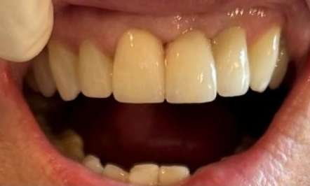 Bridge Results 