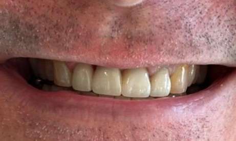 Bridge Results 