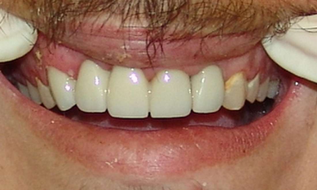 Bridge Results 