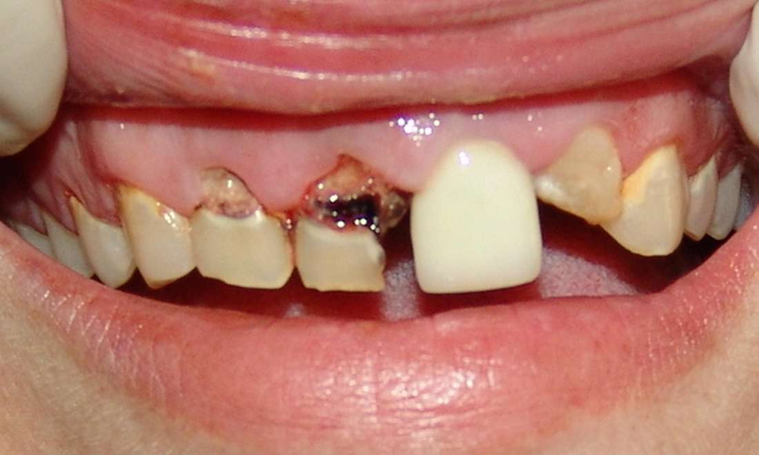Bridge Results 