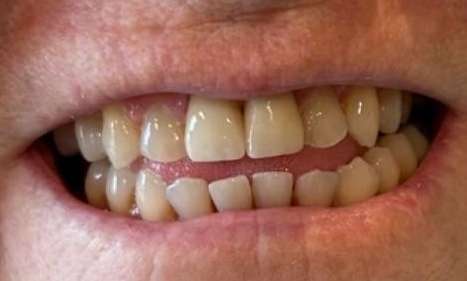 Porcelain-Veneers-After-Image