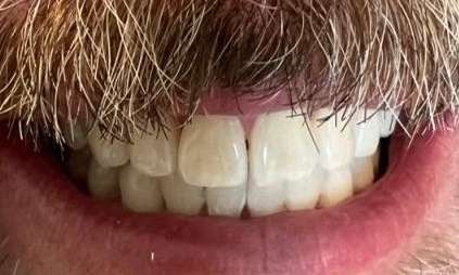 ZooM-Bleaching-After-Image