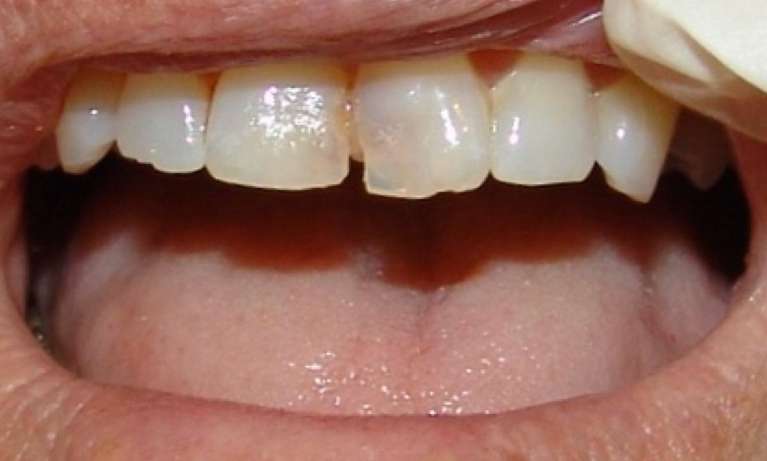 Crowns-Before-Image