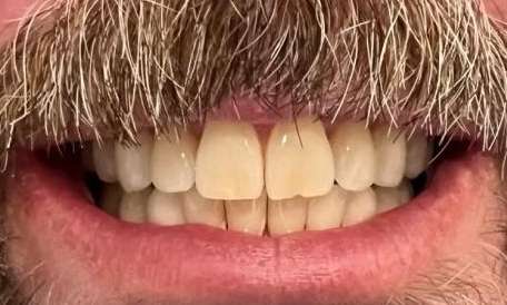 ZooM-Bleaching-Before-Image